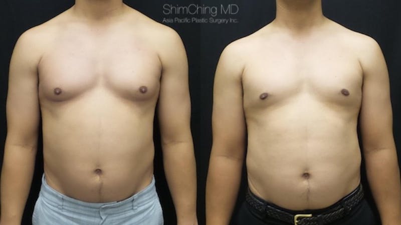 male breast reduction gynecomastia