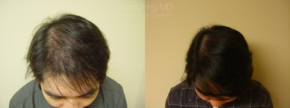 Hair Restoration Before & After Gallery - Patient 38307518 - Image 1