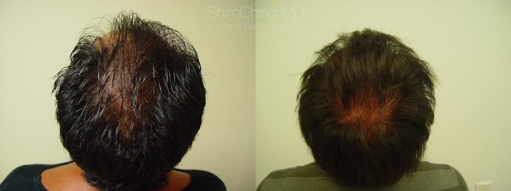 Hair Restoration Before & After Gallery - Patient 38307520 - Image 1