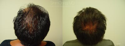 Hair Restoration Gallery - Patient 38307520 - Image 1