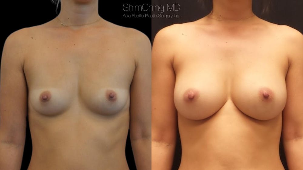 Asian Breast Implants Before & After Gallery - Patient 38307521 - Image 1