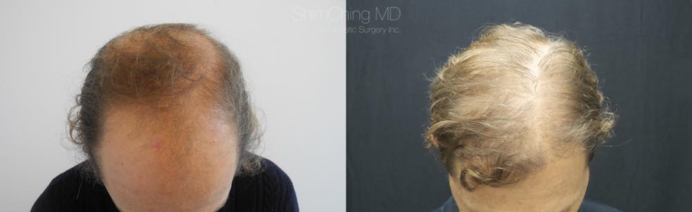 Hair Restoration Before & After Gallery - Patient 38307522 - Image 1