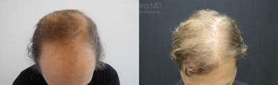 Hair Restoration Before & After Gallery - Patient 38307522 - Image 1