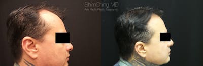Hair Restoration Before & After Gallery - Patient 38307524 - Image 1