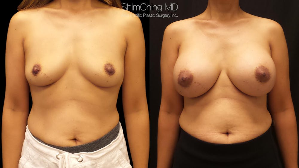 Asian Breast Implants Before & After Gallery - Patient 38307525 - Image 1