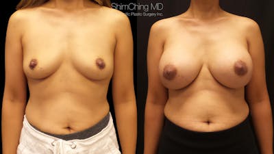 Asian Breast Implants Before & After Gallery - Patient 38307525 - Image 1