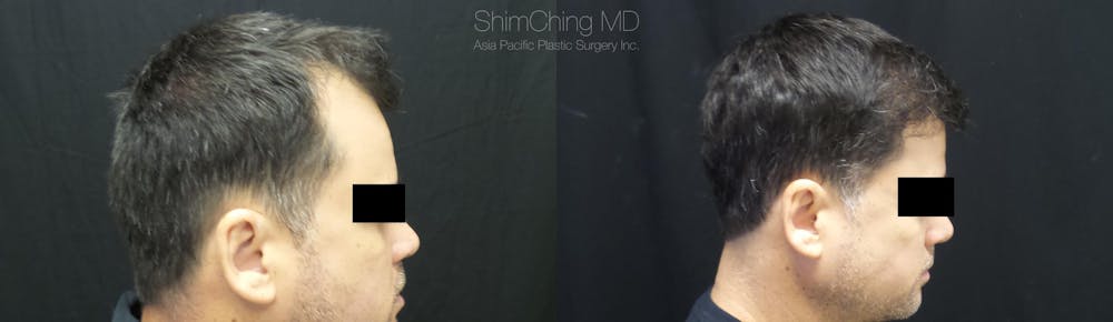 Hair Restoration Before & After Gallery - Patient 38307528 - Image 3