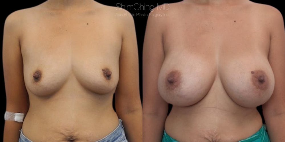 Asian Breast Implants Before & After Gallery - Patient 38307527 - Image 1