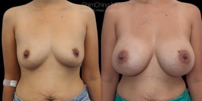 Asian Breast Implants Before & After Gallery - Patient 38307527 - Image 1