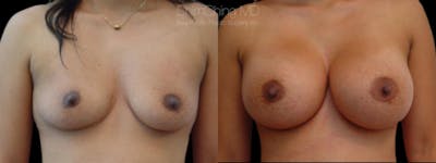 Asian Breast Implants Before & After Gallery - Patient 38307529 - Image 1