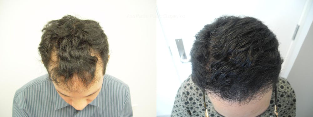 Hair Restoration Before & After Gallery - Patient 38307530 - Image 1