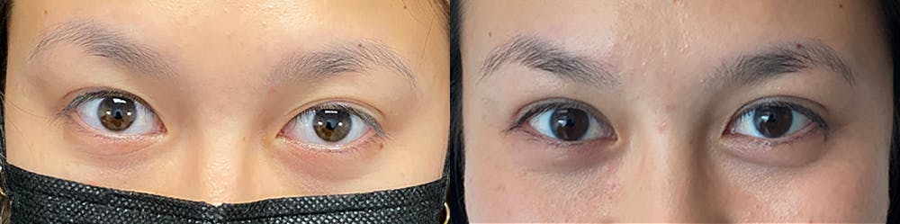 Eyelid Surgery Before & After Gallery - Patient 47088152 - Image 1