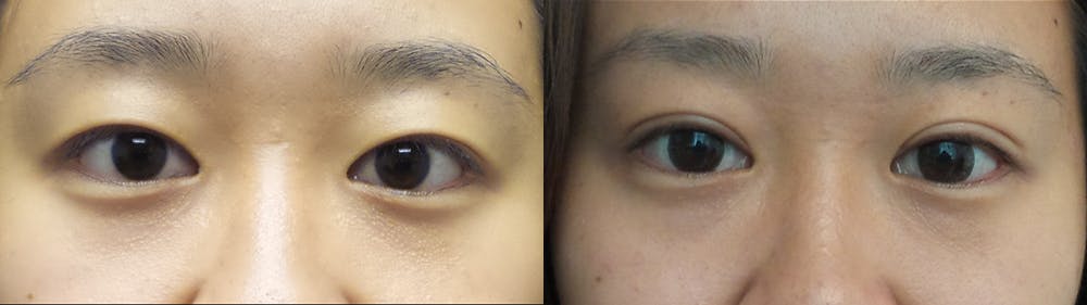 Eyelid Surgery Before & After Gallery - Patient 47088154 - Image 1