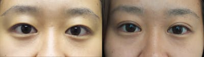 Eyelid Surgery Before & After Gallery - Patient 47088154 - Image 1