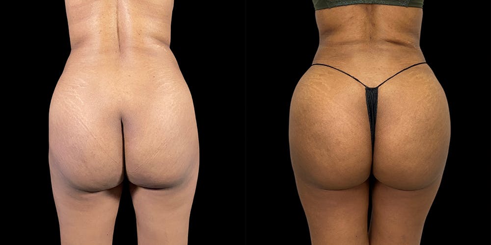 Brazilian Butt Lift Before & After Gallery - Patient 47088232 - Image 1
