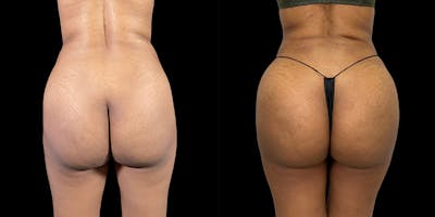 Brazilian Butt Lift Before & After Gallery - Patient 47088232 - Image 1