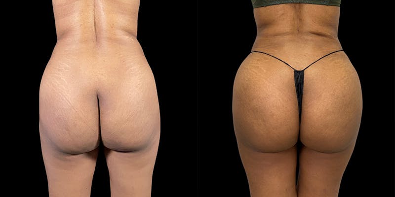 Brazilian Butt Lift