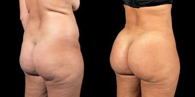 Brazilian Butt Lift Before & After Gallery - Patient 47088233 - Image 1
