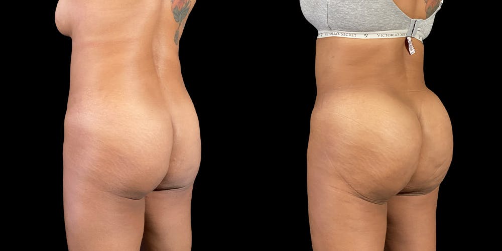 Brazilian Butt Lift Before & After Gallery - Patient 47088234 - Image 1