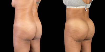 Brazilian Butt Lift Before & After Gallery - Patient 47088234 - Image 1