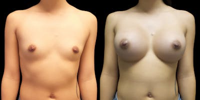 Breast Augmentation Before & After Gallery - Patient 47089193 - Image 1
