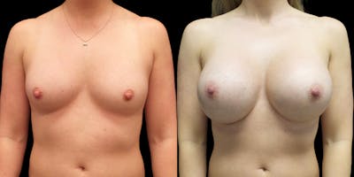 Breast Augmentation Before & After Gallery - Patient 47089194 - Image 1