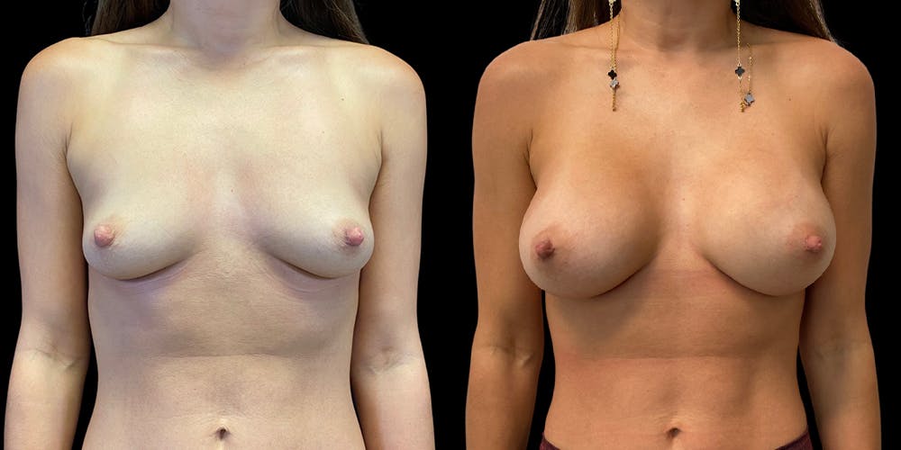 Breast Augmentation Before & After Gallery - Patient 47089195 - Image 1