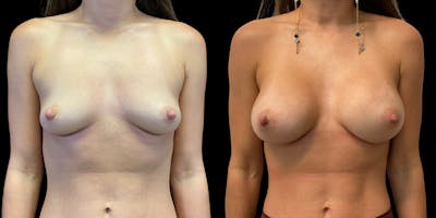Breast Augmentation Before & After Gallery - Patient 47089195 - Image 1