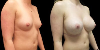 Breast Augmentation Before & After Gallery - Patient 47089194 - Image 2