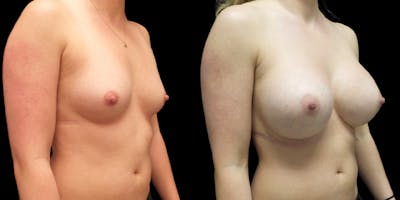 Breast Augmentation Gallery - Patient 47089194 - Image 2