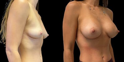 Breast Augmentation Gallery - Patient 47089195 - Image 2