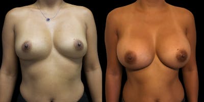 Breast Augmentation Before & After Gallery - Patient 47089196 - Image 1