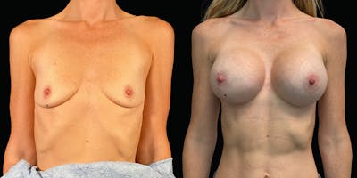 Breast Augmentation Before & After Gallery - Patient 47089197 - Image 1