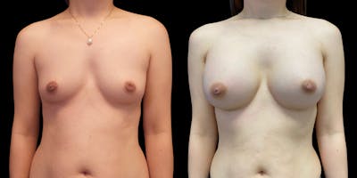 Breast Augmentation Before & After Gallery - Patient 47089198 - Image 1