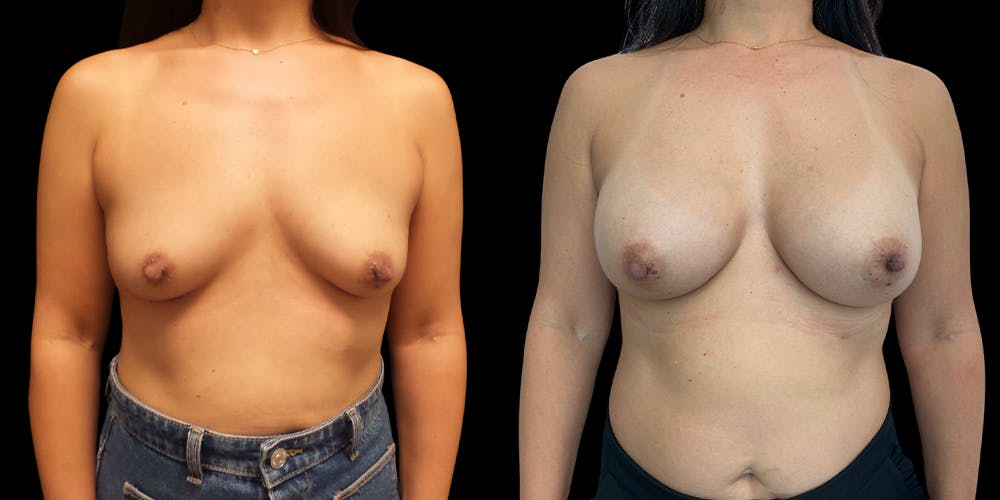 Breast Augmentation Before & After Gallery - Patient 47089199 - Image 1