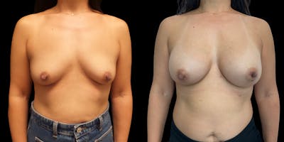Breast Augmentation Before & After Gallery - Patient 47089199 - Image 1