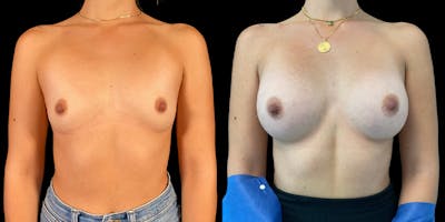 Breast Augmentation Before & After Gallery - Patient 47089200 - Image 1