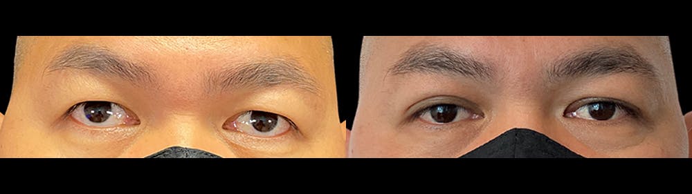 Eyelid Surgery Before & After Gallery - Patient 47088153 - Image 1