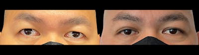 Eyelid Surgery Before & After Gallery - Patient 47088153 - Image 1