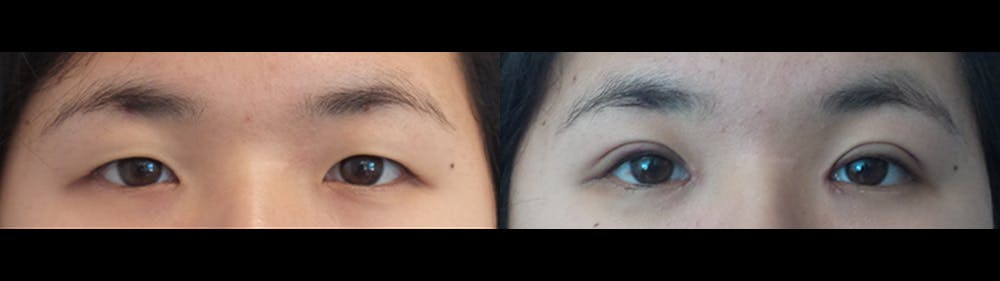 Eyelid Surgery Before & After Gallery - Patient 47088155 - Image 1