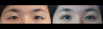 Eyelid Surgery Before & After Gallery - Patient 47088155 - Image 1