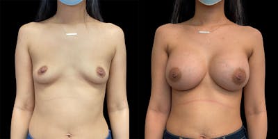 Breast Augmentation Before & After Gallery - Patient 50508412 - Image 1