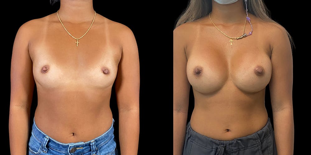 Breast Augmentation Before & After Gallery - Patient 50511183 - Image 1