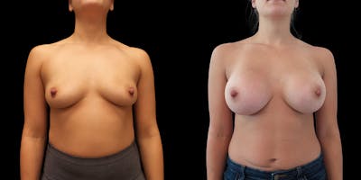 Breast Augmentation Before & After Gallery - Patient 50511204 - Image 1