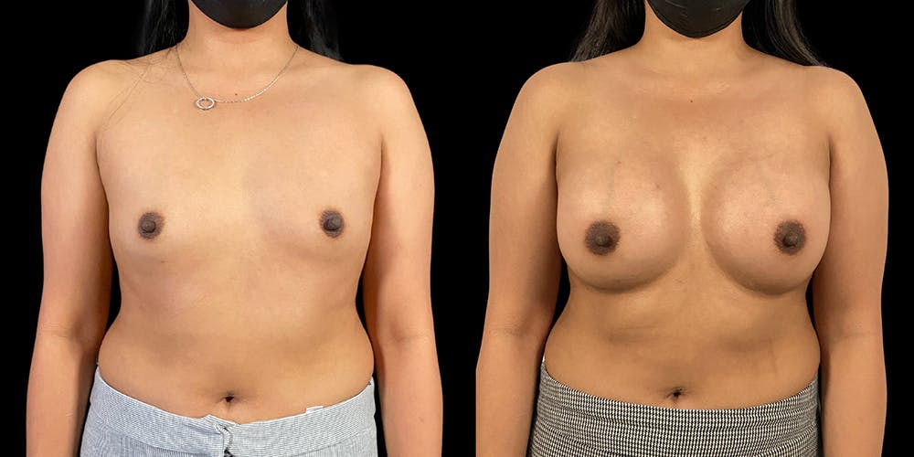 Breast Augmentation Before & After Gallery - Patient 50511214 - Image 1