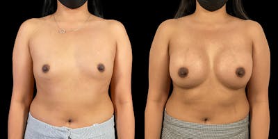 Breast Augmentation Before & After Gallery - Patient 50511214 - Image 1