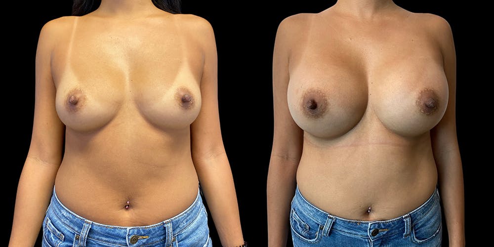Breast Augmentation Before & After Gallery - Patient 50511251 - Image 1