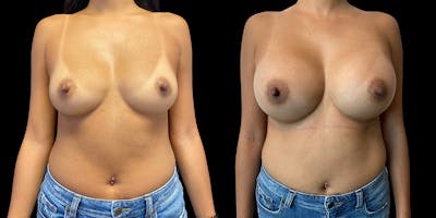 Breast Augmentation Before & After Gallery - Patient 50511251 - Image 1