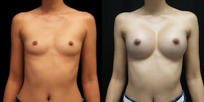 Breast Augmentation Before & After Gallery - Patient 50511260 - Image 1