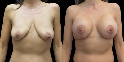 Breast Lift with Implants Gallery - Patient 53828525 - Image 1
